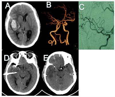 Case Report: Ruptured Middle Cerebral Artery Aneurysm With Intrasylvian Hematoma Successfully Treated by Coil Embolization and Minimally Invasive Puncture and Drainage